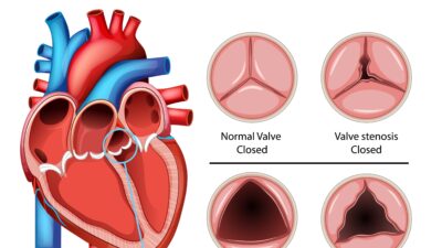 Aortic Stenosis Treatment by a TAVI Expert