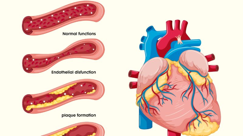 Get a Second Opinion Angioplasty in Heart From Dr. Raghu in Hyderabad