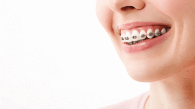 Braces Brighton VIC: How to Look After Your Teeth During Treatment